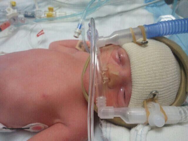 a premature baby on CPAP in the NICU.