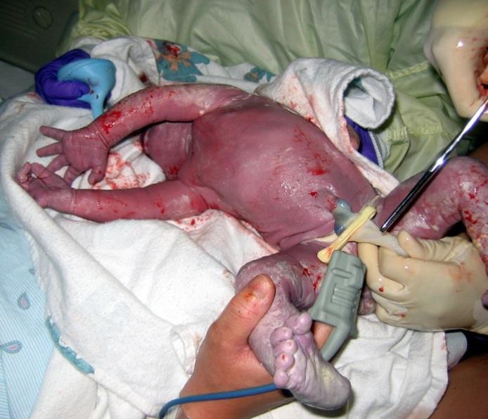 The clamping and cutting of a newborn’s umbilical cord